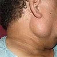 Symptoms of Mucoepidermoid Tumor and Treatment 