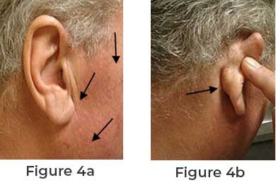 Facial Nerve Cancer and Parotid Tumor Surgery What You Need to Know