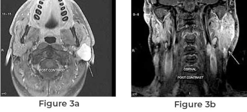 Parotidectomy and Facelift to Remove Parotid Gland and Rejuvenate the Appearance 
